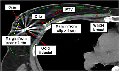 First Experience in Korea of Stereotactic Partial Breast Irradiation for Low-Risk Early-Stage Breast Cancer